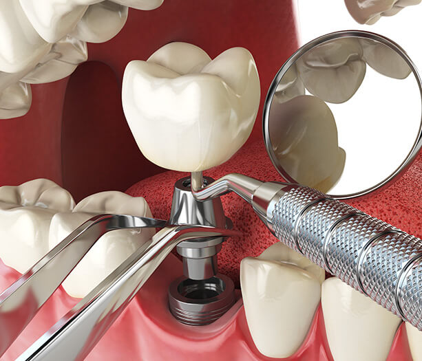 dental implant process