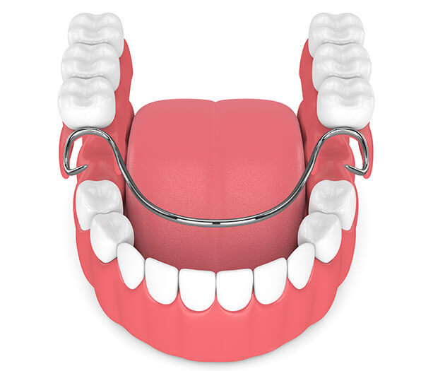 Partial Dentures