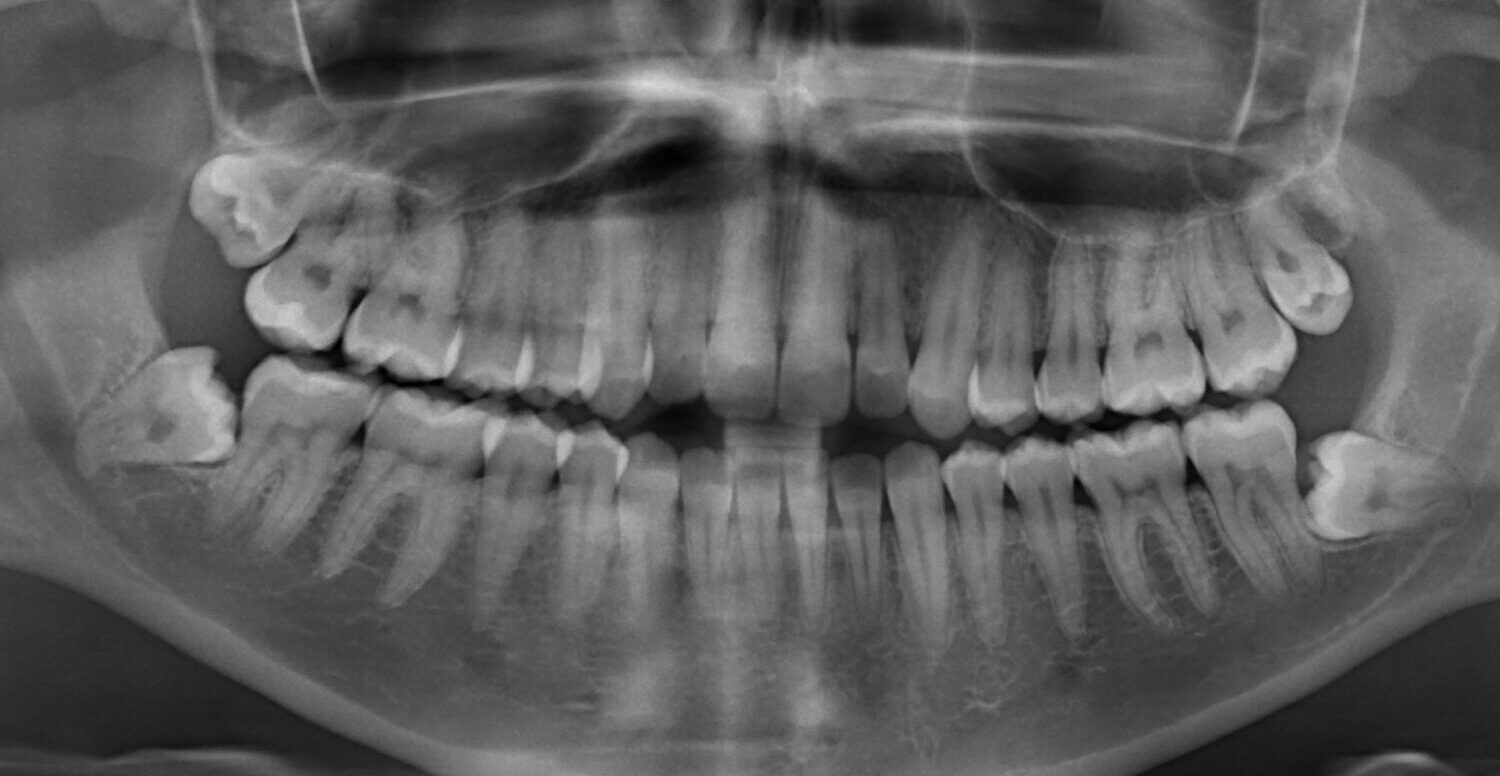 Panoramic X-ray showing 4 wisdom teeth that need to be removed