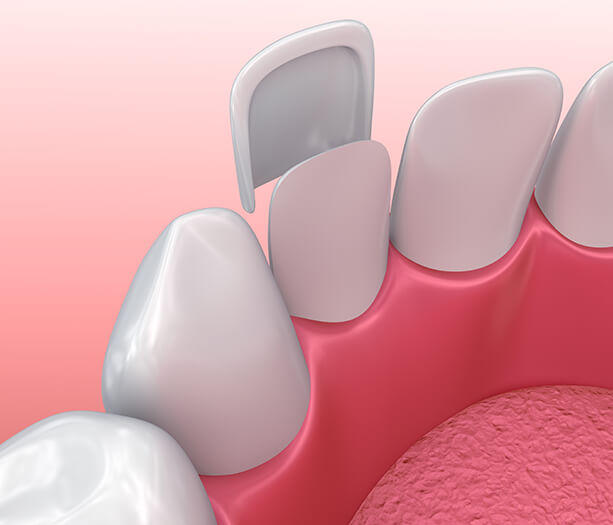 illustration of a dental veneer