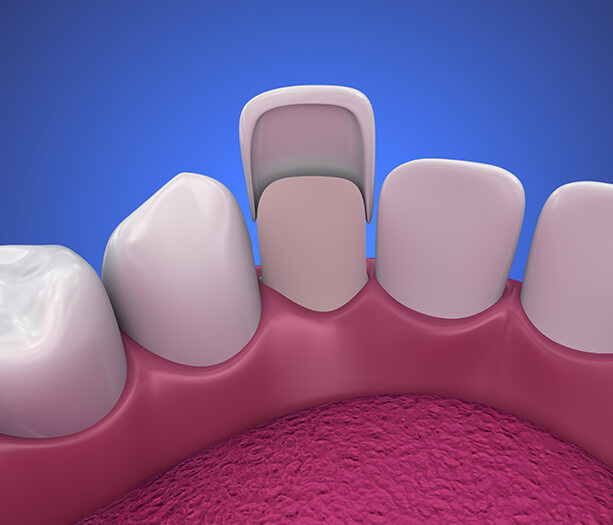 illustration of a dental veneer