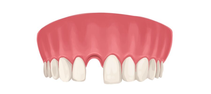 Drawing of an upper gum arch missing a front tooth