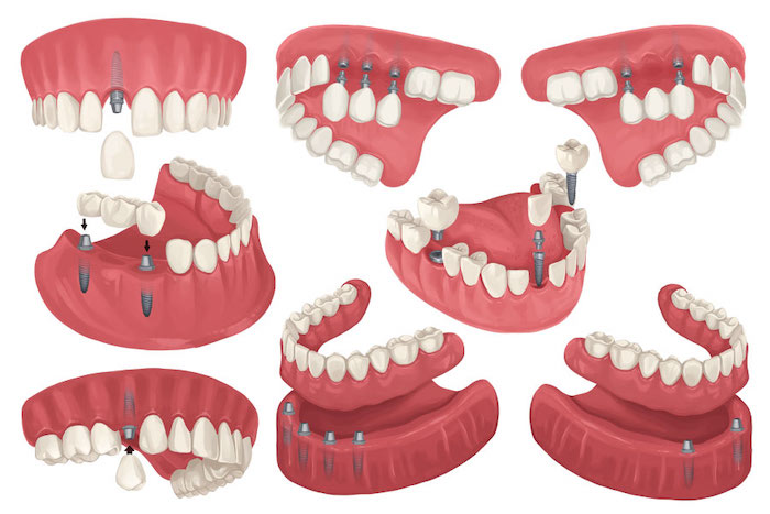 Different configurations of dental implants