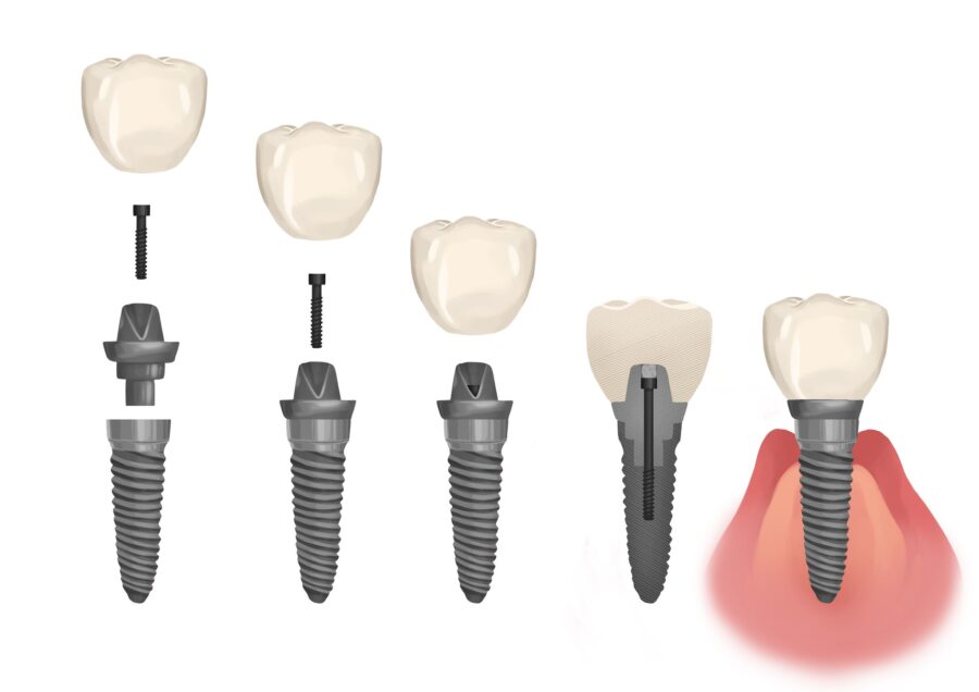 Illustration of the structure of a dental implant tooth replacement