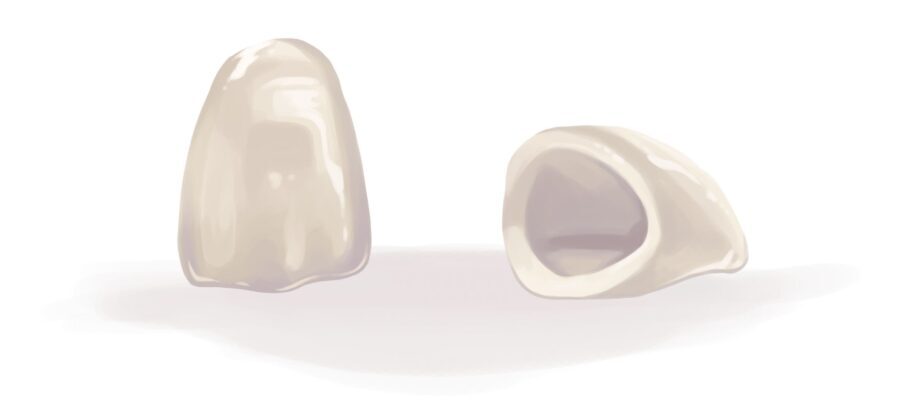 Illustration of a porcelain dental crown to cap a natural tooth