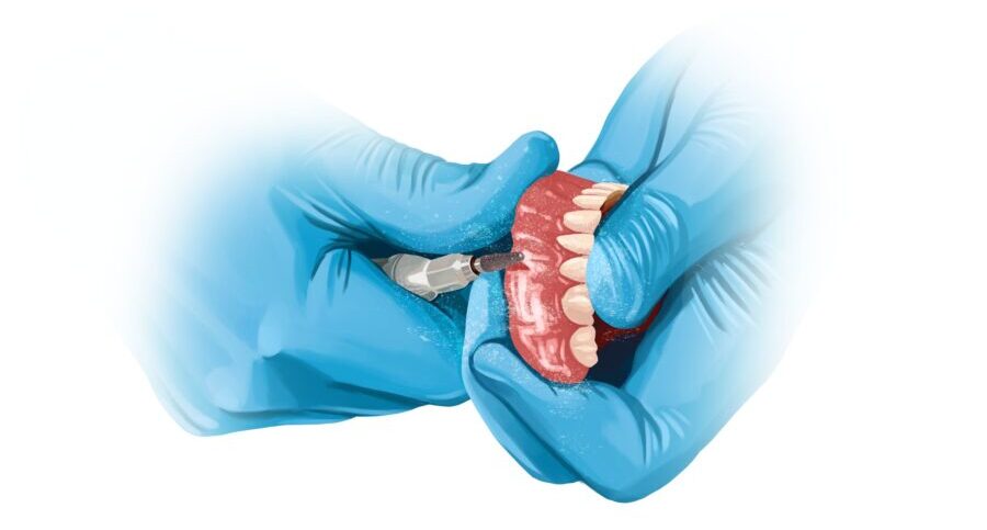 Illustration of blue gloved hands of a prosthodontist adjusting dentures to replace missing teeth for a patient