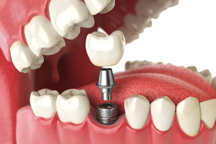 Closeup of a missing molar being replaced with a dental implant