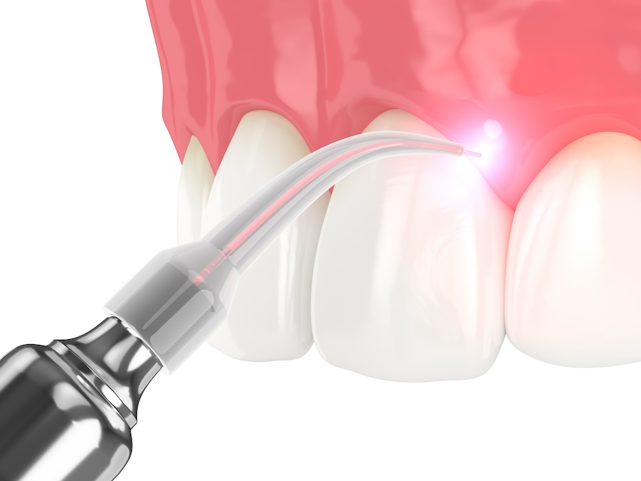 dental lasers, laser dentistry, Rockingham Prosthodontics, Dr. Rigby, Harrisonburg VA, dental laser safety, laser gum therapy, dental technology