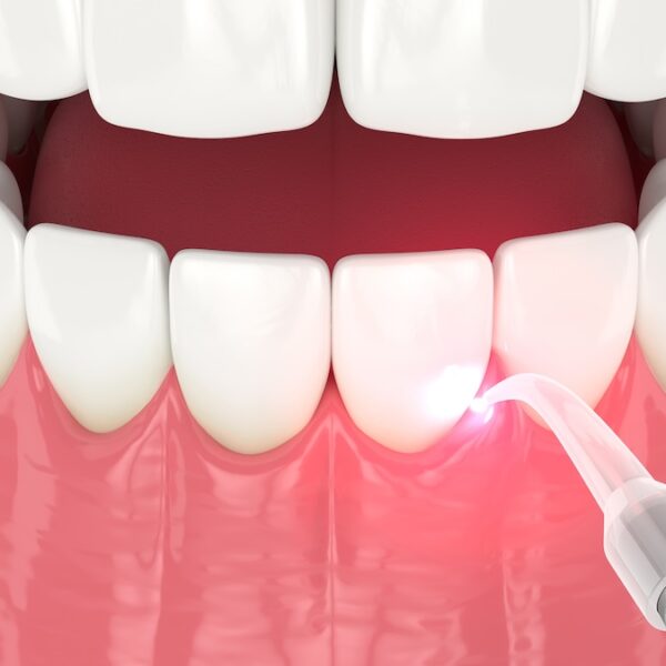 LANAP laser gum surgery, gum disease