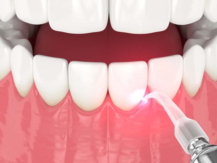 LANAP laser gum surgery, gum disease