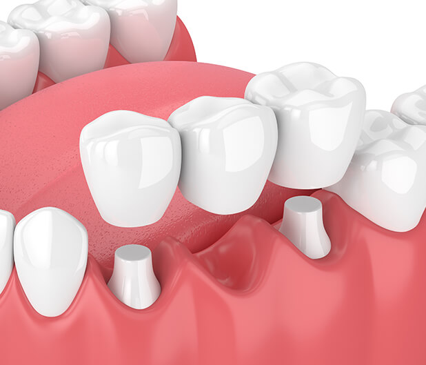 illustration of a dental bridge