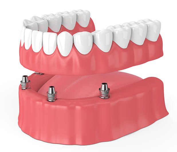 illustration of implant-supported dentures