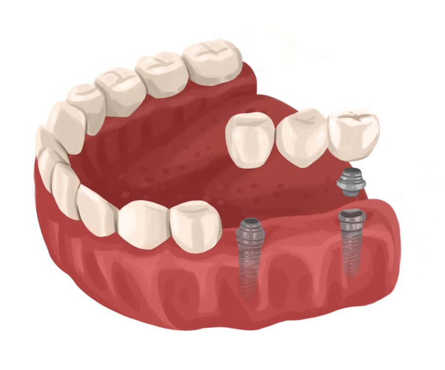implant supported bridge on the lower jaw